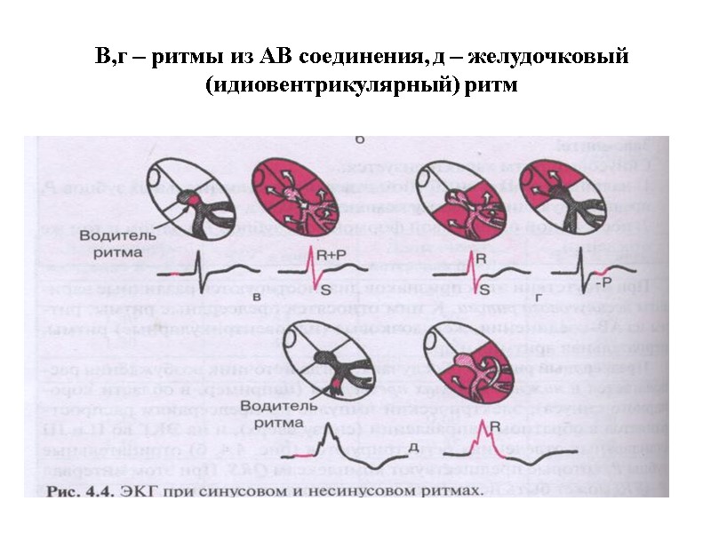 В,г – ритмы из АВ соединения, д – желудочковый (идиовентрикулярный) ритм